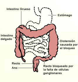 Hirschsprung - esquema de intestino afectado